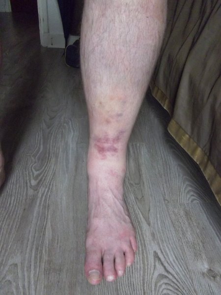Saturday 16th June 2012.jpg - Saturday evening after three matches and before the march around Paris. The slight yellow bruising above the red mark is the spot where Chris's knee made contact.